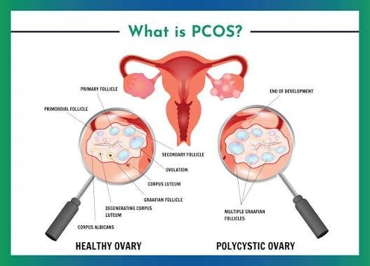 PCOS & Hormonal Disorders
